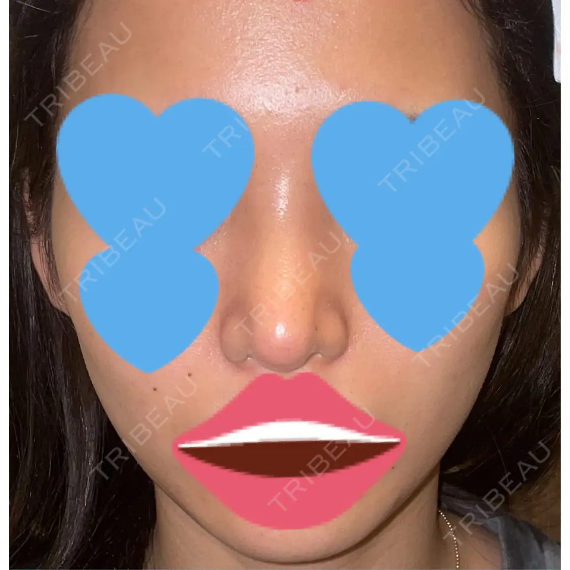 隆鼻術 / 鼻尖形成（切開） / 糸リフト / 軟骨移植 / ヒアルロン酸注入（頬） ASTRA BEAUTY CLINIC AFTER