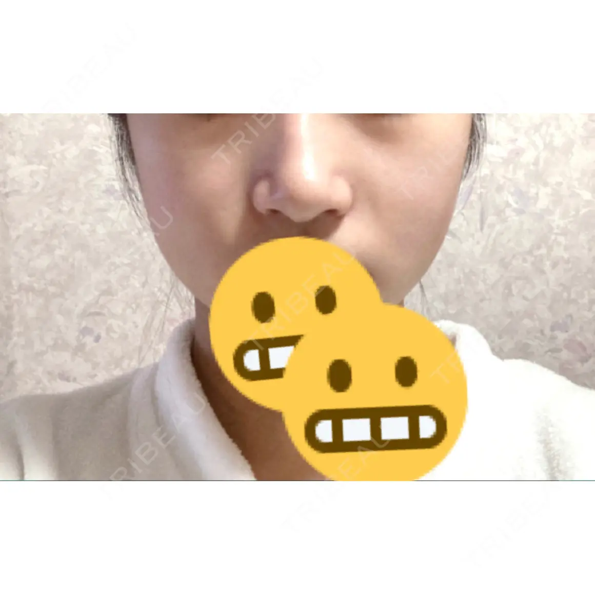 鼻尖形成（切開） / 小鼻縮小（切開） / 軟骨移植 / ワシ鼻修正・ハンプ切除 X CLINIC 大阪院 DAY 26