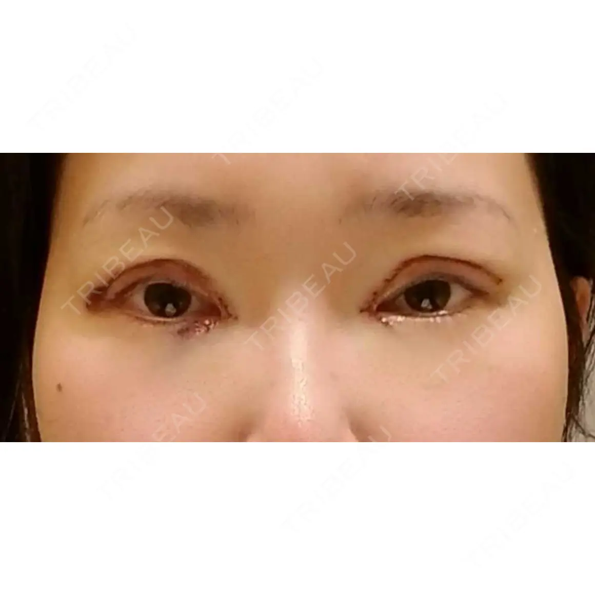 二重切開 / 目頭切開 / 眼瞼下垂（切開） / 目元修正 聖心美容クリニック 札幌院 DAY 0