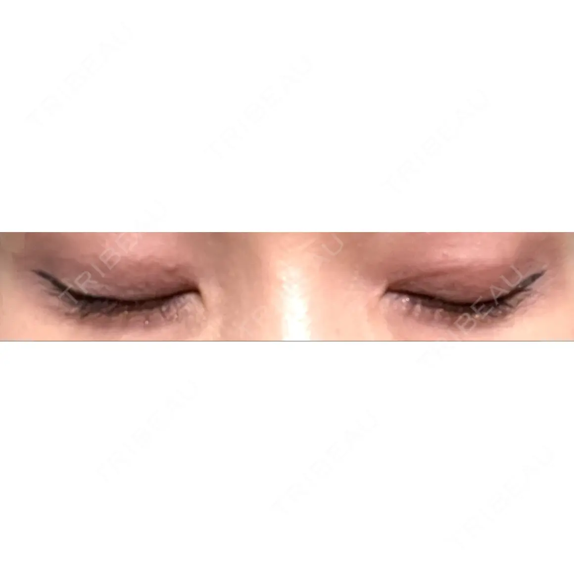 二重埋没 HAAB×DREAM BEAUTY CLINIC 大阪梅田院 AFTER