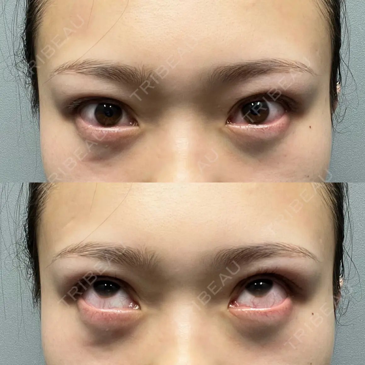 下まぶたの脂肪取り 品川美容外科 渋谷院（※品川スキンクリニック提携） DAY 0