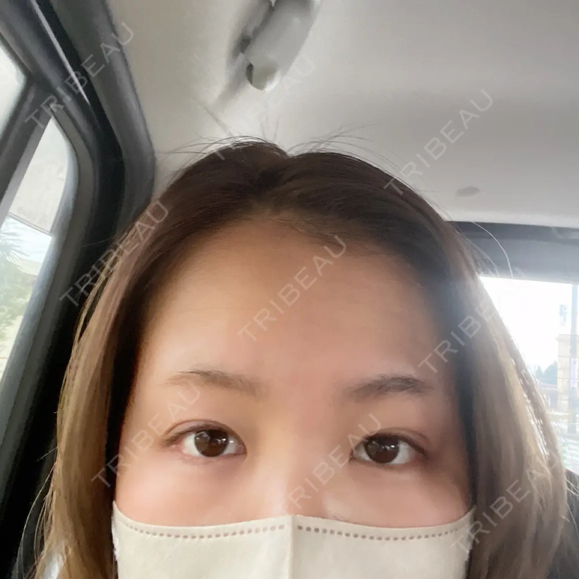 二重埋没 アリエル美容クリニック 郡山院 DAY 1