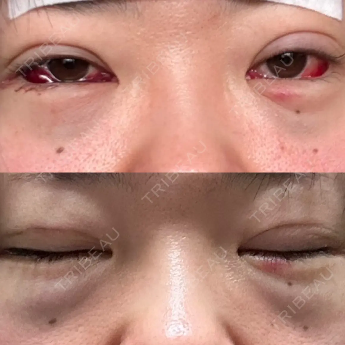 二重埋没 / 下まぶたの脂肪取り アリエル美容クリニック 郡山院 DAY 0