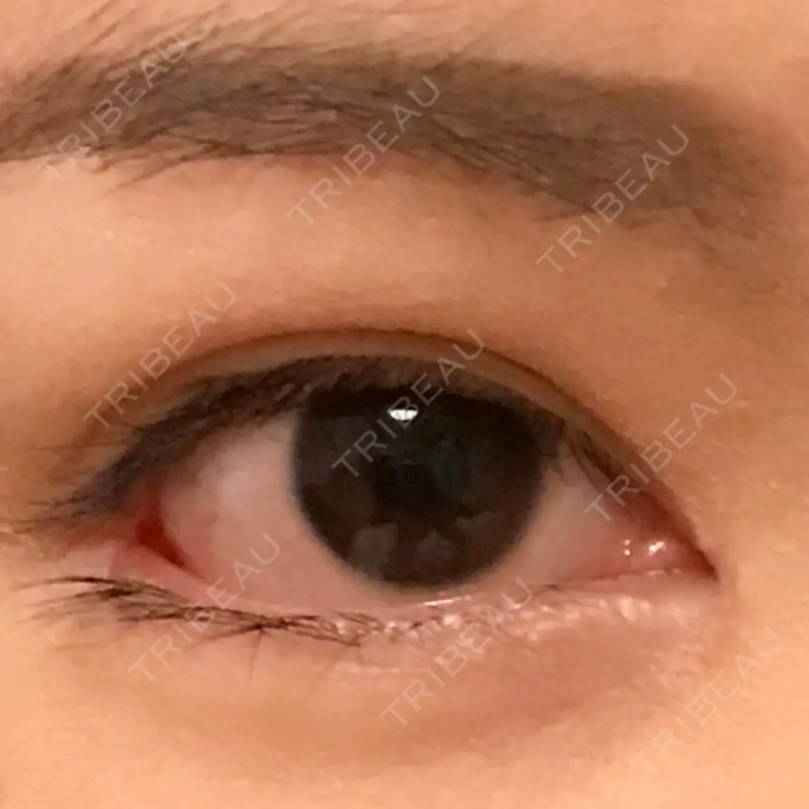 目頭切開 / 目尻切開 / 目尻靭帯移動 FROM B整形外科 (旧バウム整形外科) AFTER