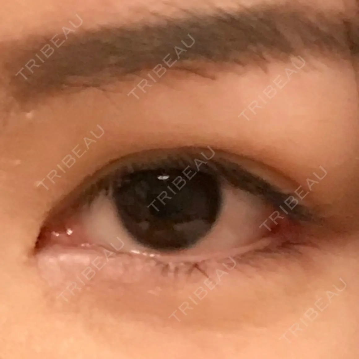 目頭切開 / 目尻切開 / 目尻靭帯移動 FROM B整形外科 (旧バウム整形外科) AFTER
