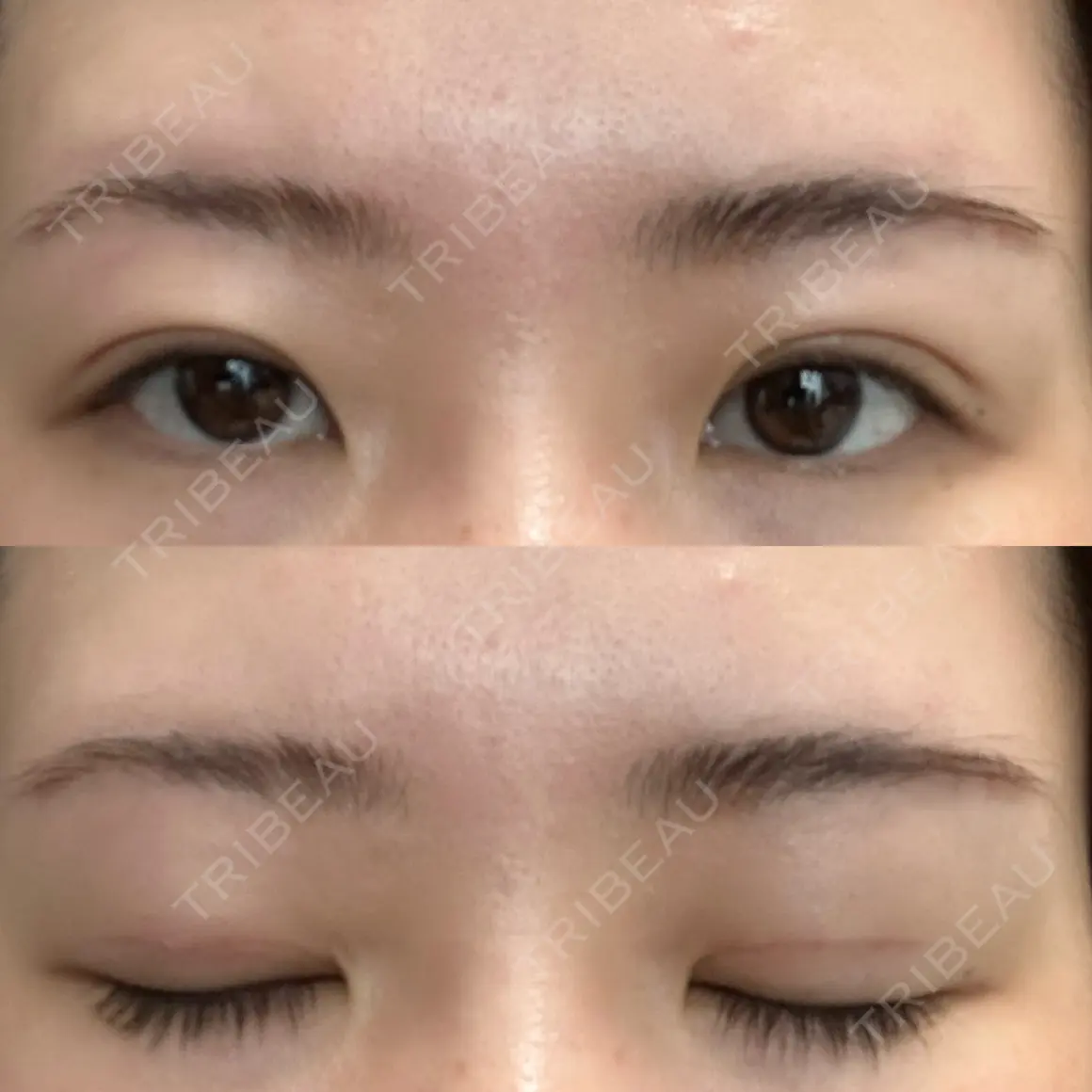 二重切開 オアシス美容外科 AFTER