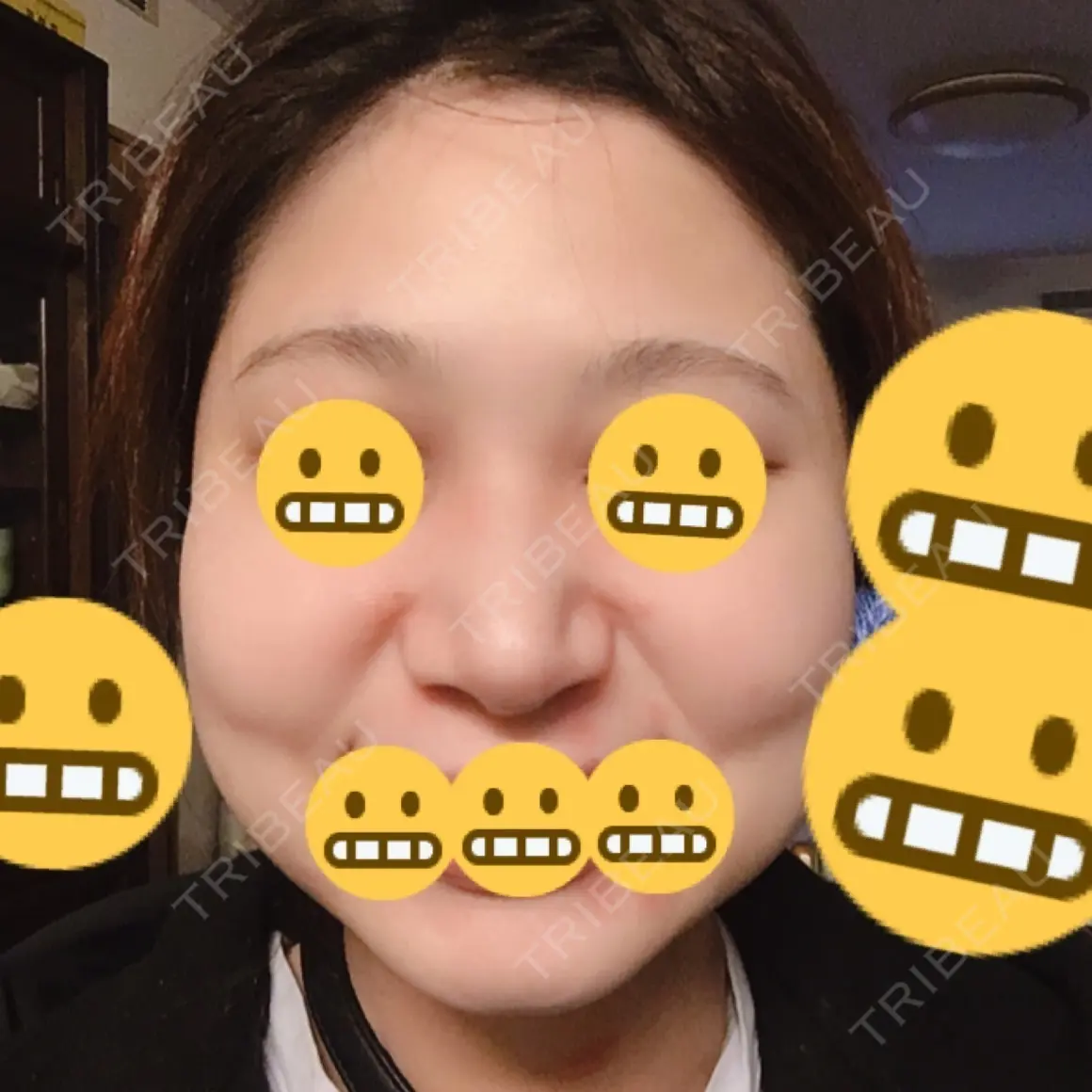 鼻尖形成（切開） / 鼻中隔延長（切開） / 骨切幅寄せ / 鼻尖縮小 ヴェリテクリニック 名古屋院 AFTER