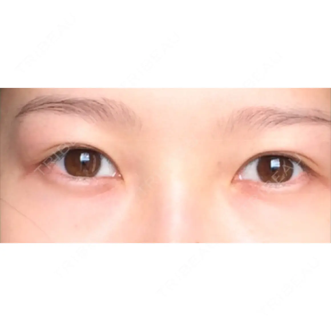 二重埋没 プレシャスクリニック自由が丘 AFTER