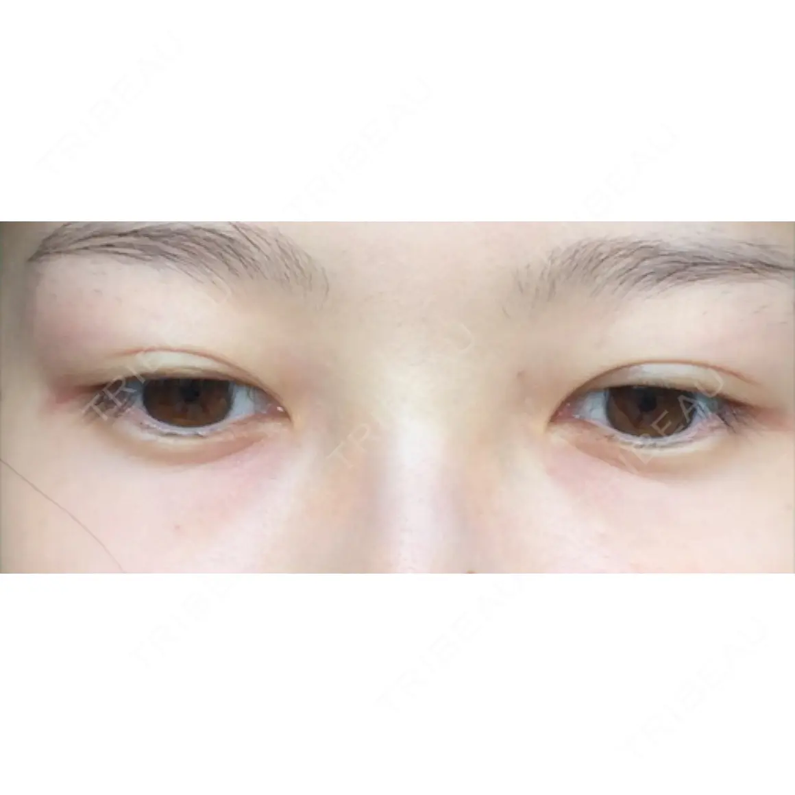 二重埋没 プレシャスクリニック自由が丘 AFTER
