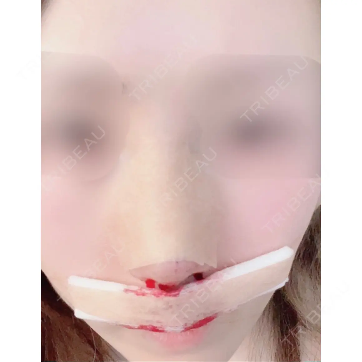軟骨移植 ソウルクイーン整形外科（旧コエンミ整形外科） DAY 0