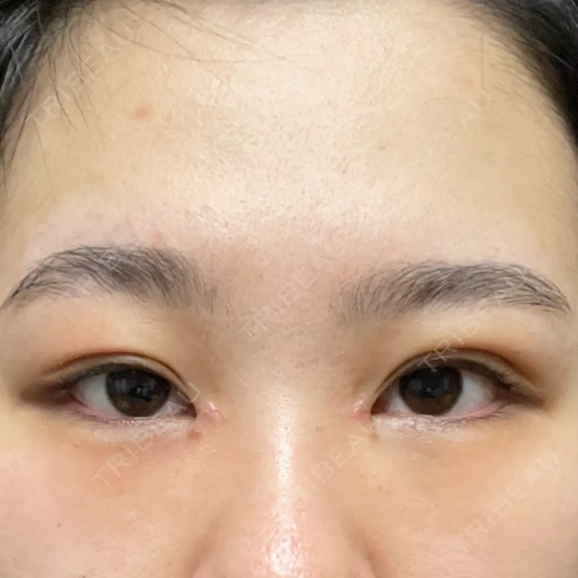 二重埋没 / 目頭切開 BELINDA CLINIC（ベリンダクリニック）新宿院 AFTER