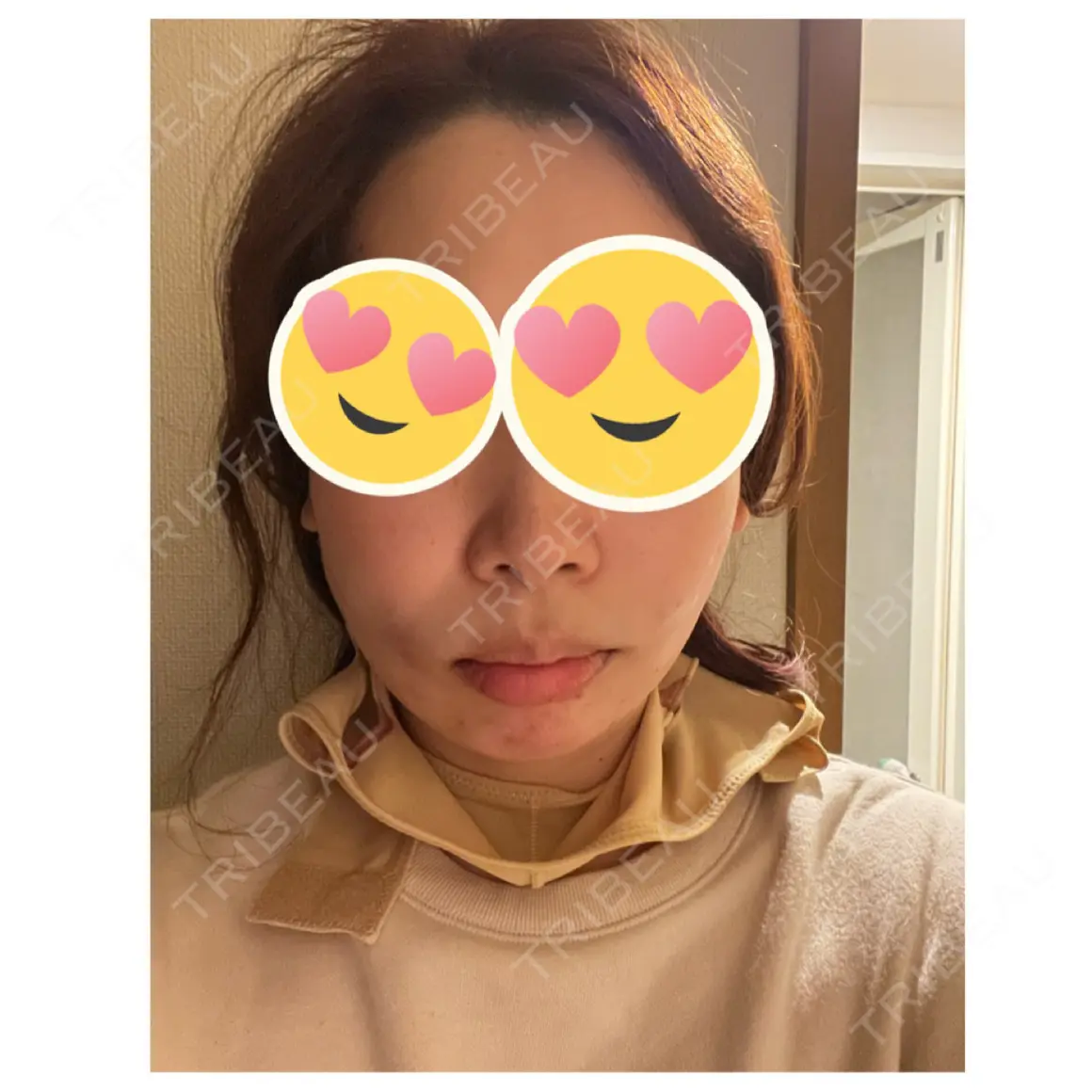 糸リフト / ジョールファット除去 ブルームクリニック（BLOOM CLINIC） DAY 0