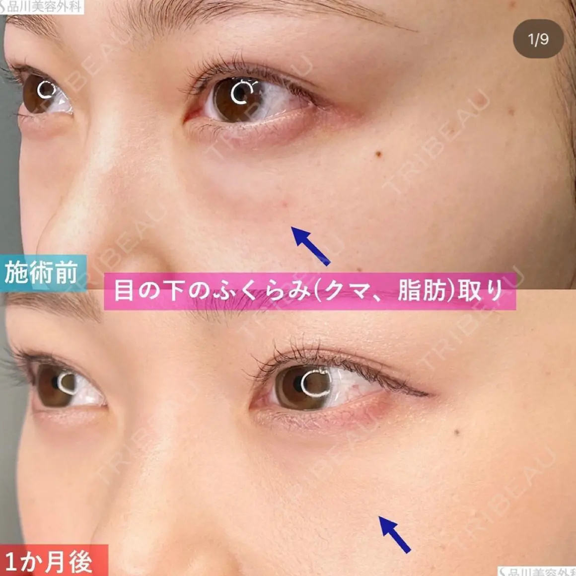 下まぶたの脂肪取り 品川美容外科 渋谷院（※品川スキンクリニック提携） AFTER