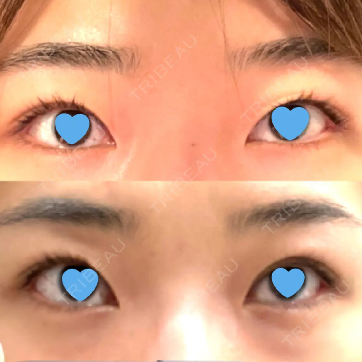 二重埋没 お茶の水美容形成クリニック DAY 0