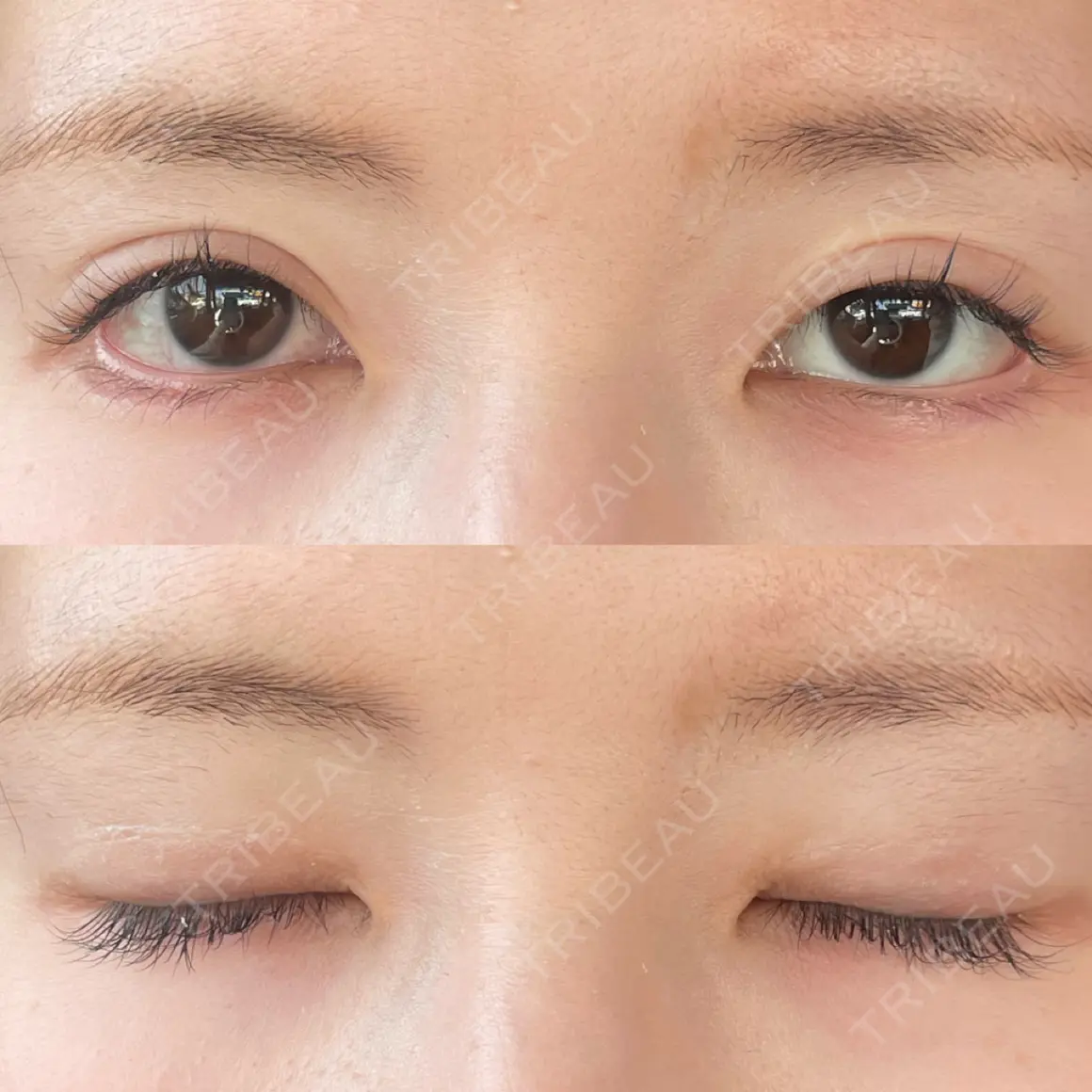 二重切開 / 眼瞼下垂（切開） / 目尻切開 / タレ目形成・グラマラスライン（切開） eクリニック 金沢本院 AFTER