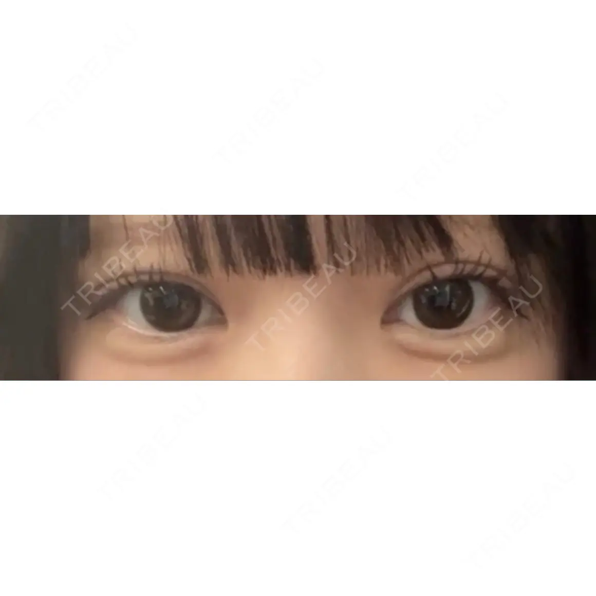ヒアルロン酸注入（涙袋） ルラ美容クリニック 渋谷本院 DAY 0