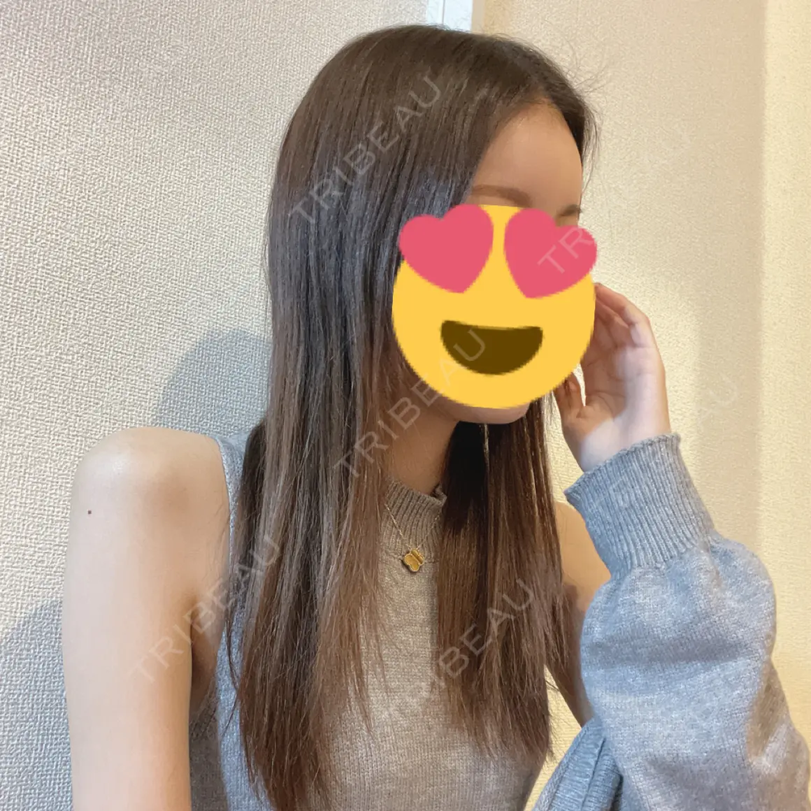 額を丸く / ヒアルロン酸注入（額） APスキンクリニック銀座 AFTER