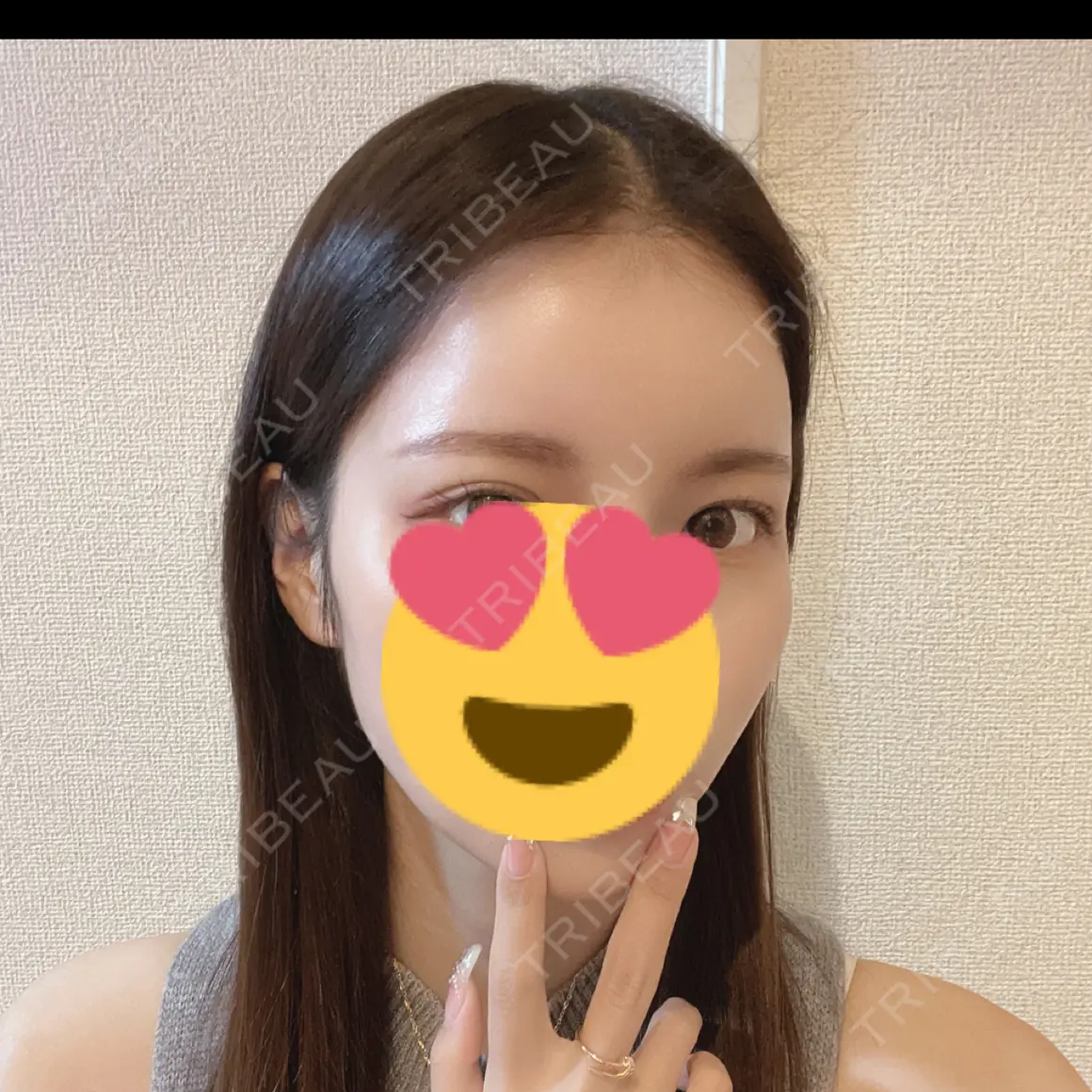 額を丸く / ヒアルロン酸注入（額） APスキンクリニック銀座 AFTER