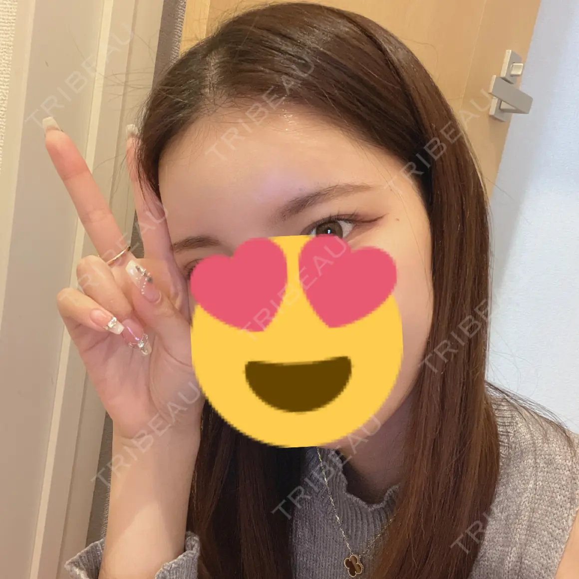 額を丸く / ヒアルロン酸注入（額） APスキンクリニック銀座 AFTER