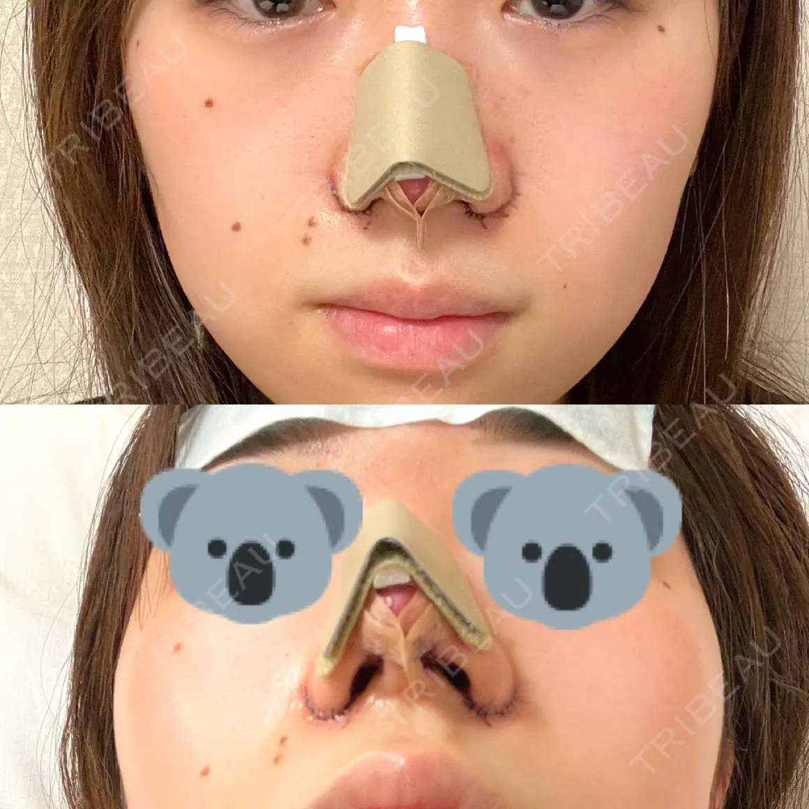 鼻尖形成（切開） / 小鼻縮小（切開） / 軟骨移植 / 鼻尖縮小 高崎美容クリニック DAY 0