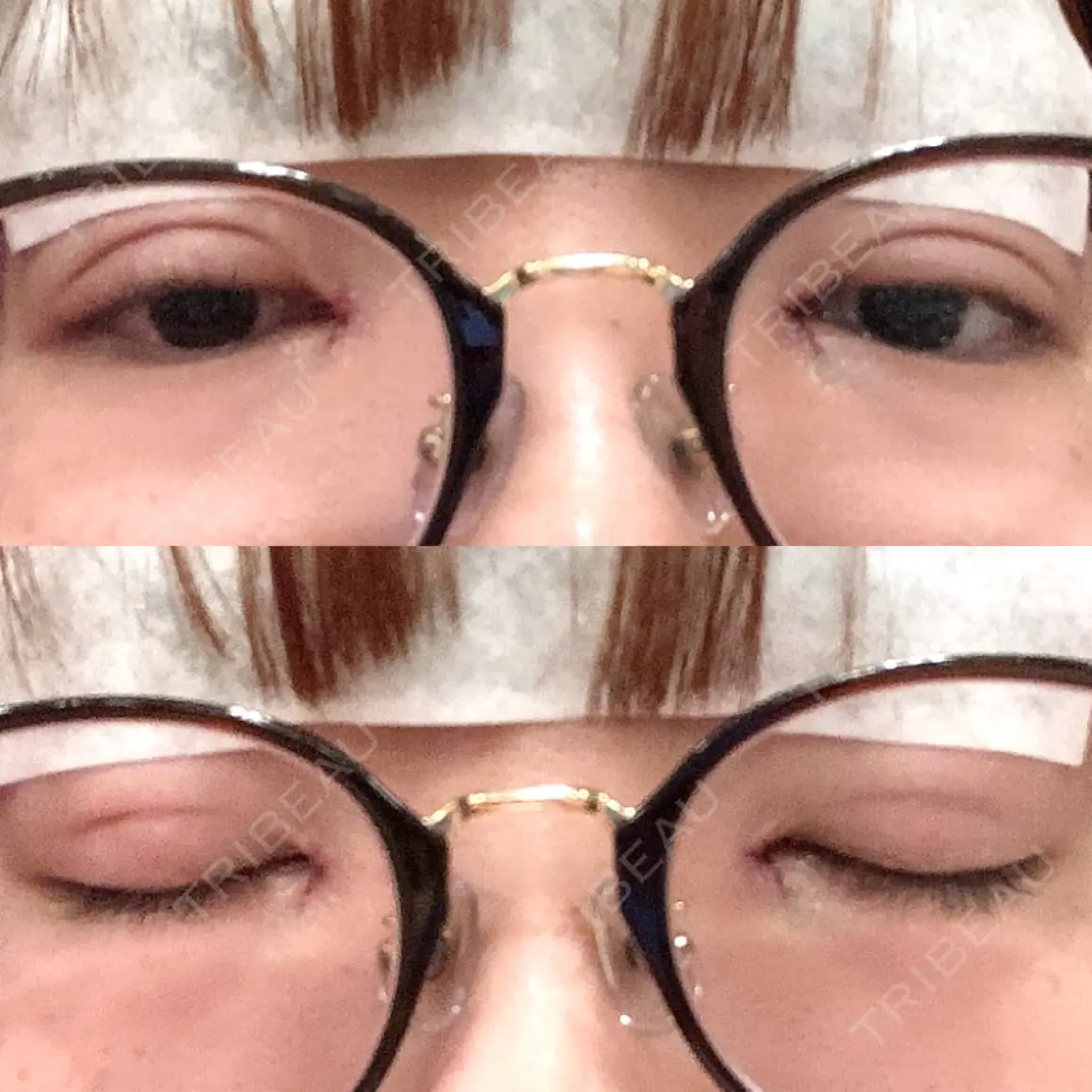 二重埋没 / 目頭切開 湘南美容クリニック 新宿本院 DAY 0