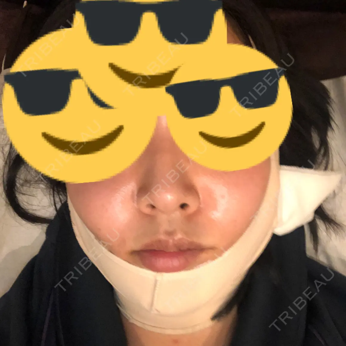 脂肪吸引（顔） THE CLINIC（ザ・クリニック） 名古屋院 DAY 0