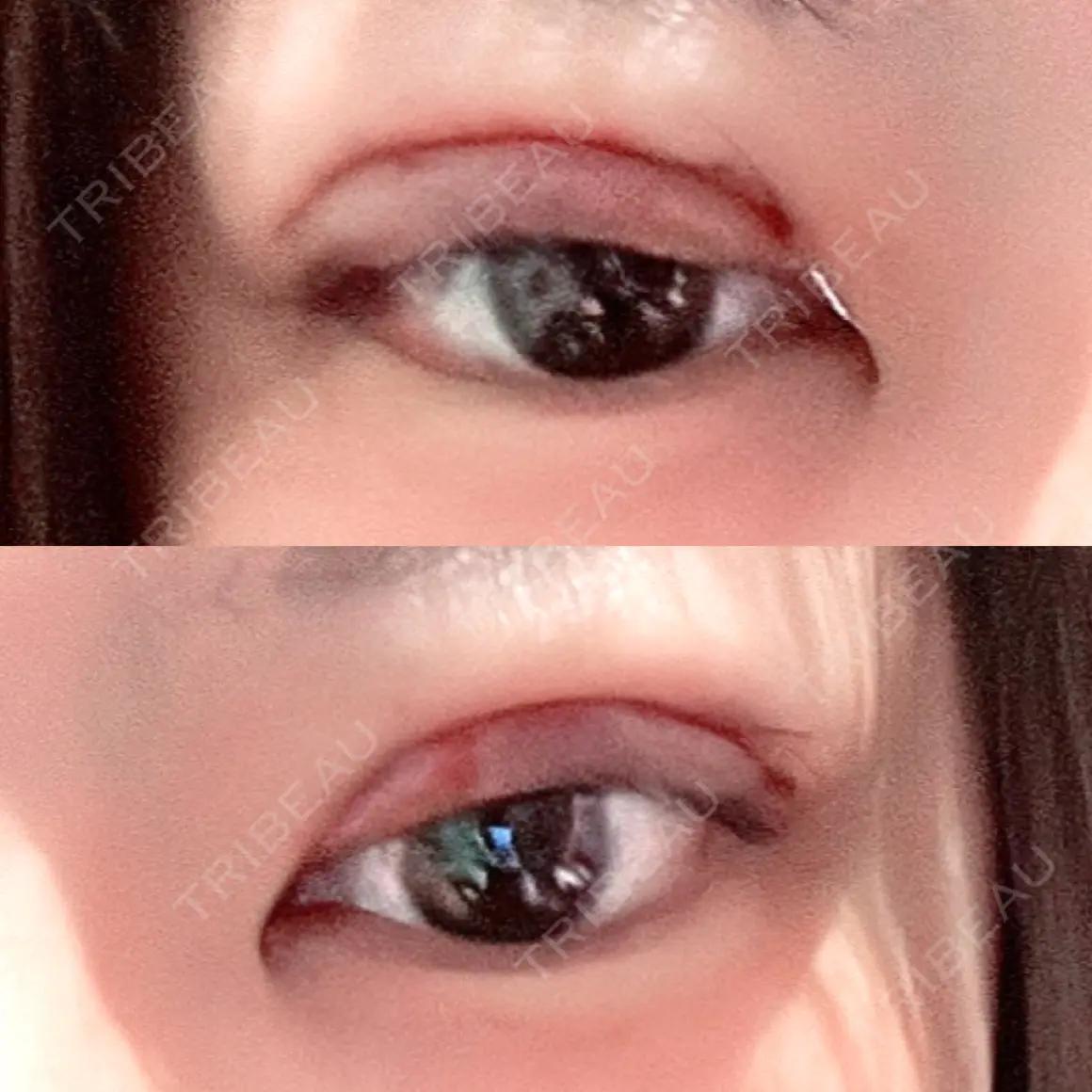 二重切開 / 眼瞼下垂（切開） / 上まぶたたるみ取り / 上まぶたの脂肪取り 湘南美容クリニック 名古屋栄院 DAY 0
