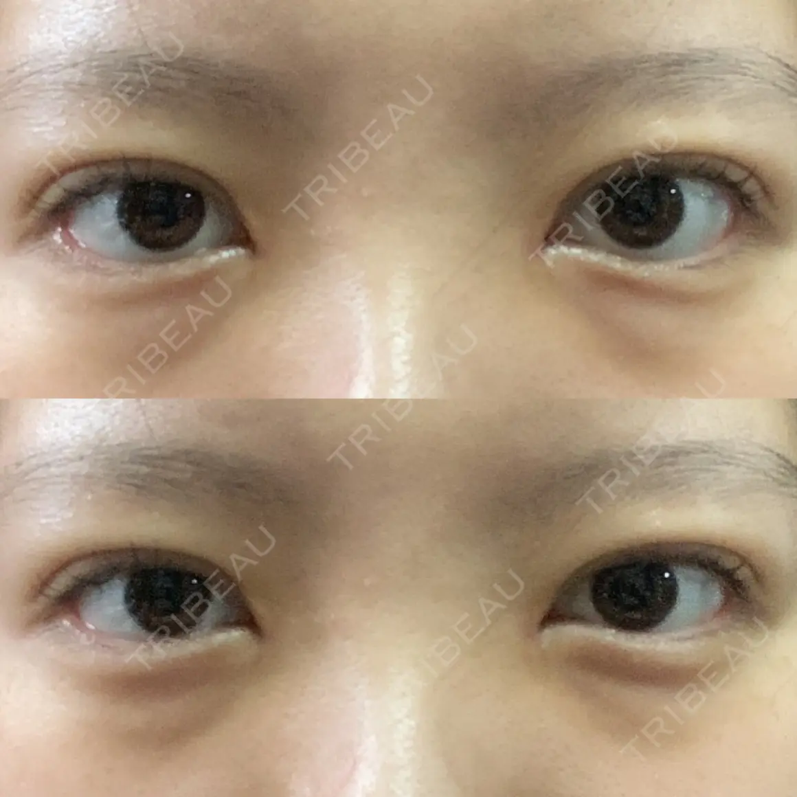 二重埋没 / 目頭切開 湘南美容クリニック 新宿本院 AFTER