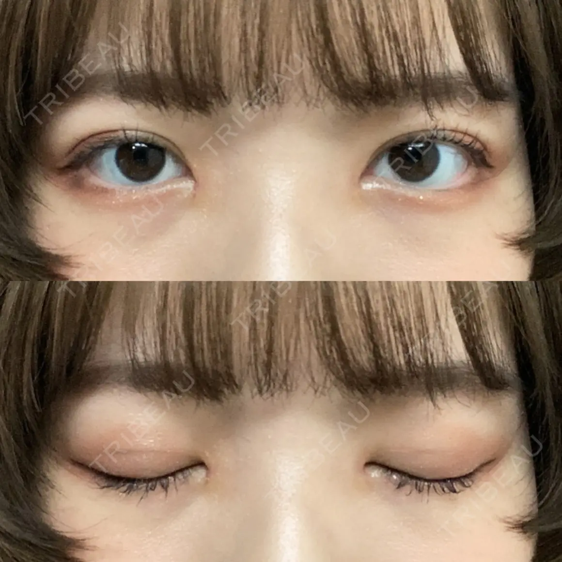 二重埋没 / 目頭切開 湘南美容クリニック 新宿本院 AFTER