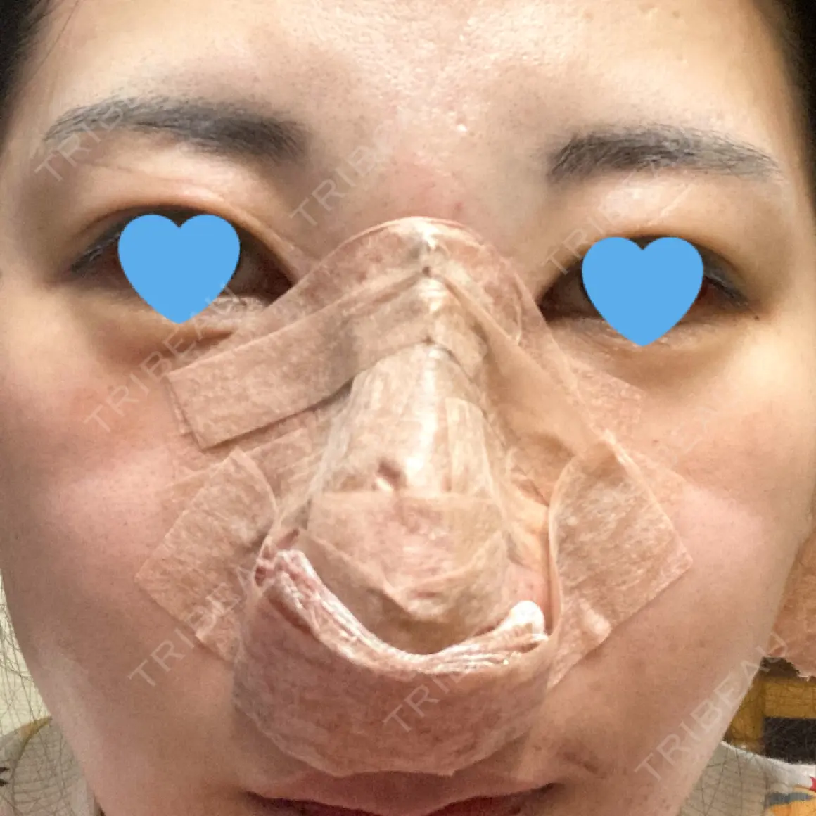 軟骨移植 / 骨切幅寄せ / ワシ鼻修正・ハンプ切除 / 鼻修正 / 鼻尖縮小 ジョウクリニック 大阪院 DAY 0