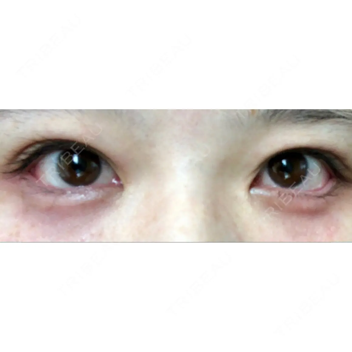 目尻切開 / 下まぶたたるみ取り / 下まぶたの脂肪取り / タレ目形成・グラマラスライン（切開） 湘南美容クリニック 表参道院 DAY 0