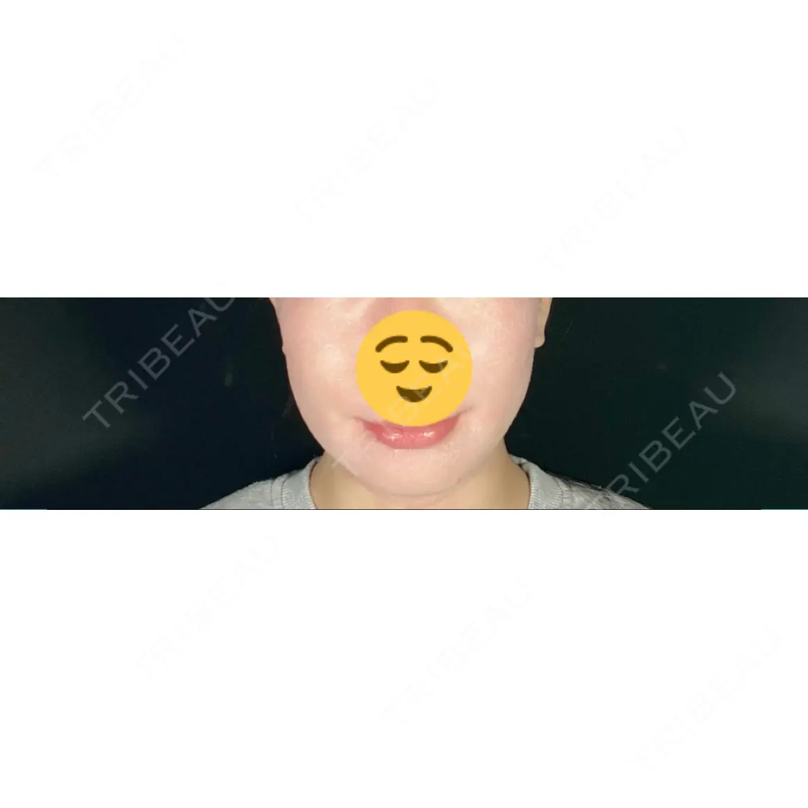 糸リフト / 脂肪吸引（顔） / ボトックス（エラ・小顔） TOTAL BEAUTY CLINIC DAY 8