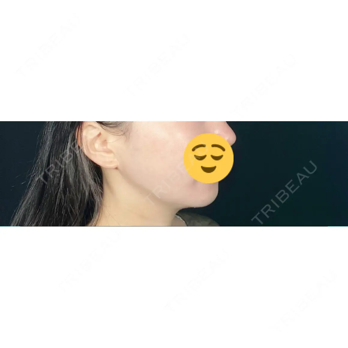 糸リフト / 脂肪吸引（顔） / ボトックス（エラ・小顔） TOTAL BEAUTY CLINIC AFTER