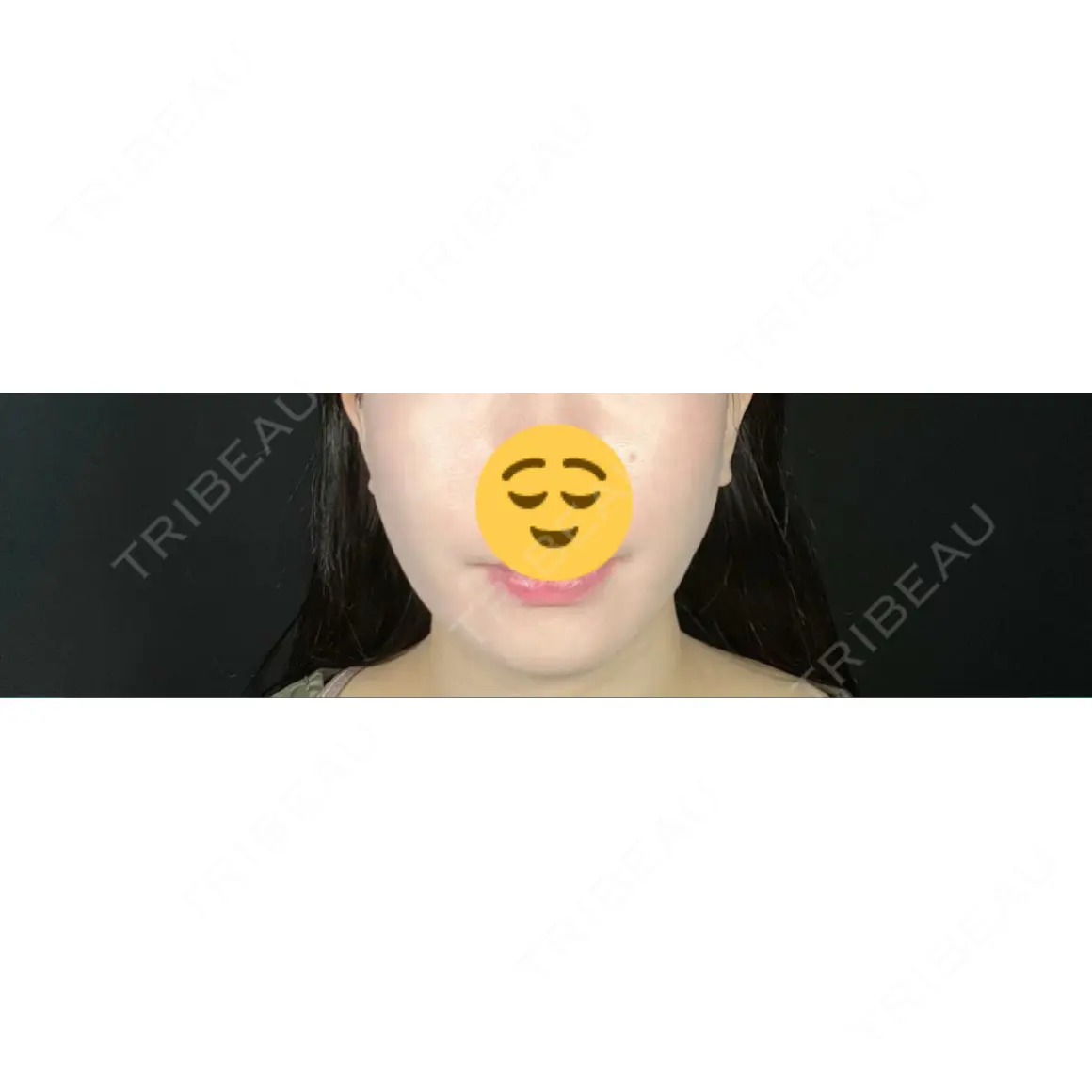 糸リフト / 脂肪吸引（顔） / ボトックス（エラ・小顔） TOTAL BEAUTY CLINIC AFTER