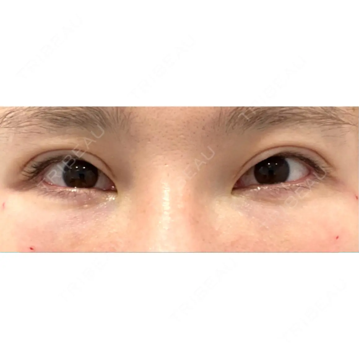 クマ治療 / 下まぶたの脂肪取り / 脂肪注入（目の下） X CLINIC 銀座院 DAY 0