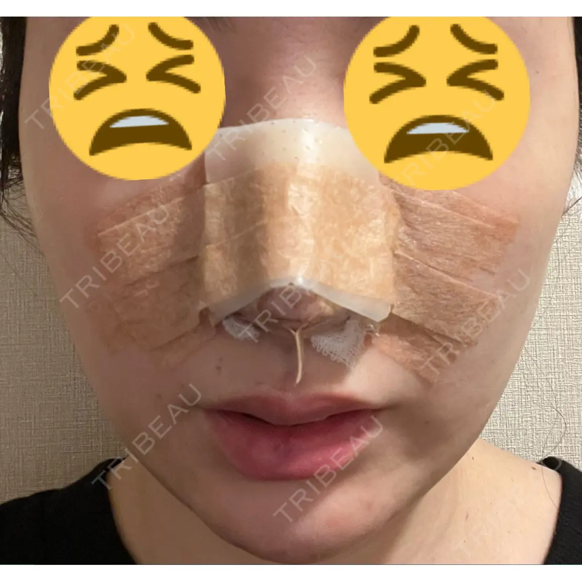 鼻尖形成（切開） / 軟骨移植 / 鼻修正 / 鼻柱下降・鼻唇角形成（猫手術） グローバルビューティークリニック 大阪院 DAY 0