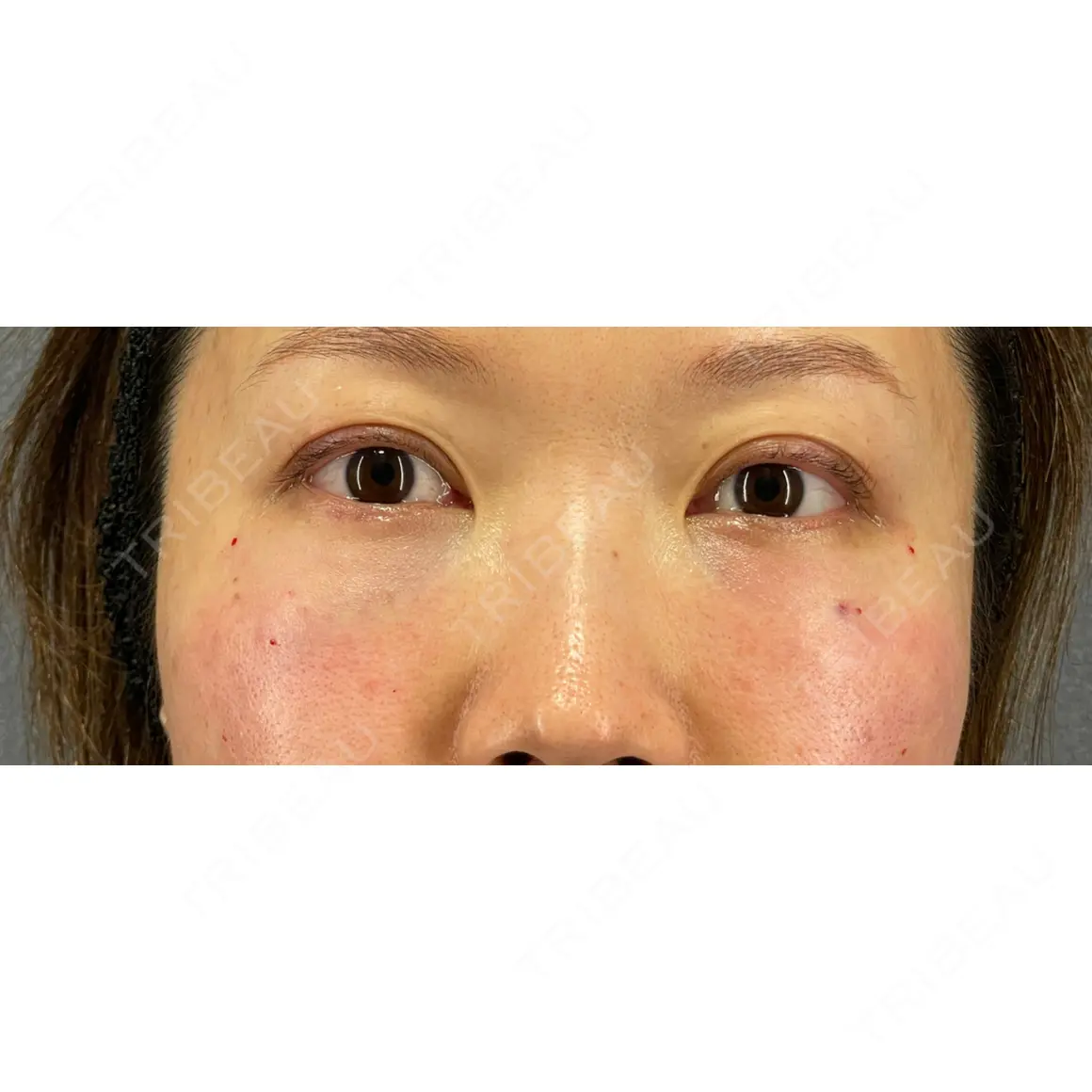 クマ治療 X CLINIC 銀座院 DAY 0