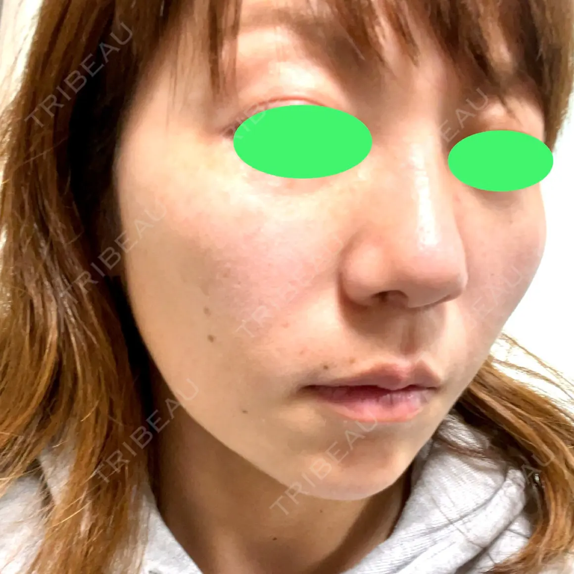 糸リフト / メーラーファット除去 TIAM CLINIC GINZA AFTER
