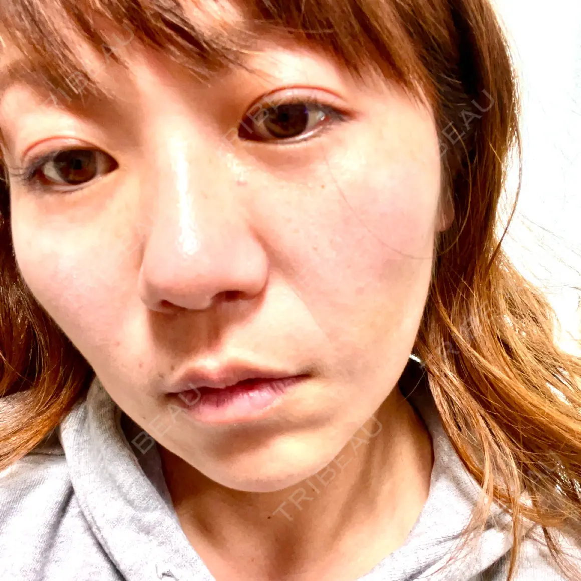 糸リフト / メーラーファット除去 TIAM CLINIC GINZA AFTER