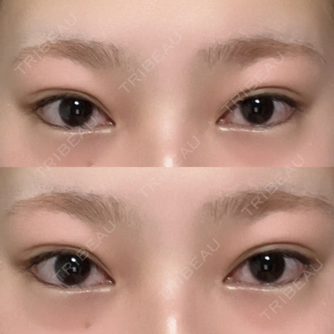 タレ目形成・グラマラスライン（切開） TIAM CLINIC GINZA AFTER