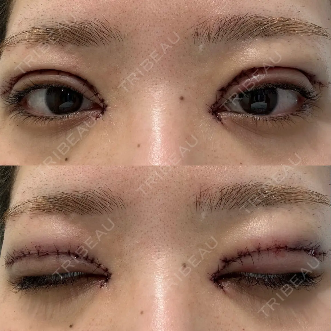 二重切開 / 目頭切開 / 眼瞼下垂（切開） Otus Clinic 【オータスクリニック】 DAY 0