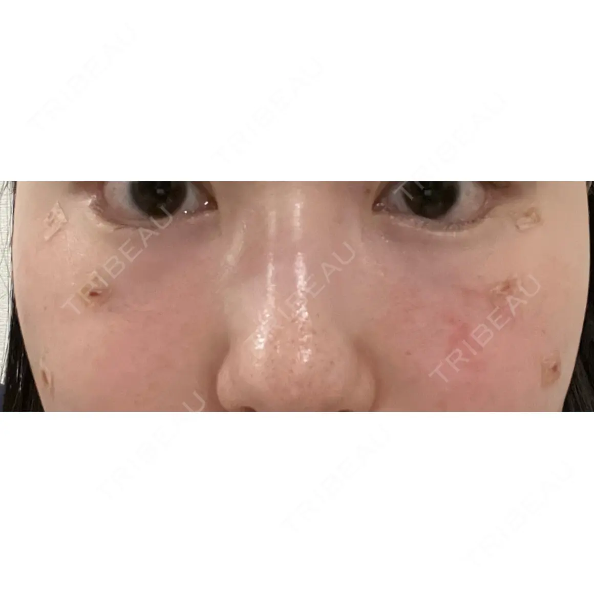 クマ治療 X CLINIC 銀座院 DAY 0