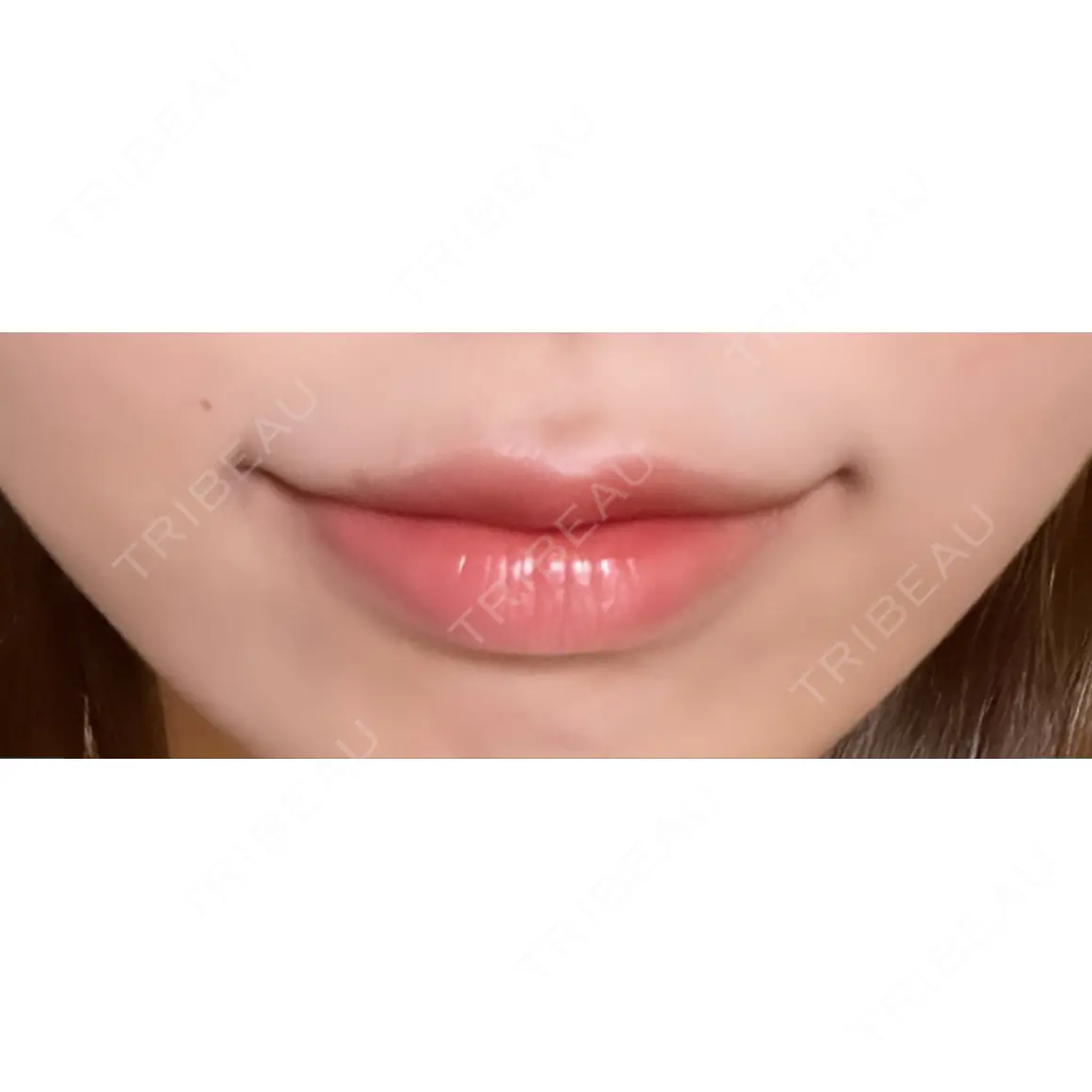 ボトックス（あご） / ヒアルロン酸注入（あご） / 脂肪溶解注射（顔） / ヒアルロン酸注入（唇） / ボトックス（口角） ルラ美容クリニック 新宿院 AFTER