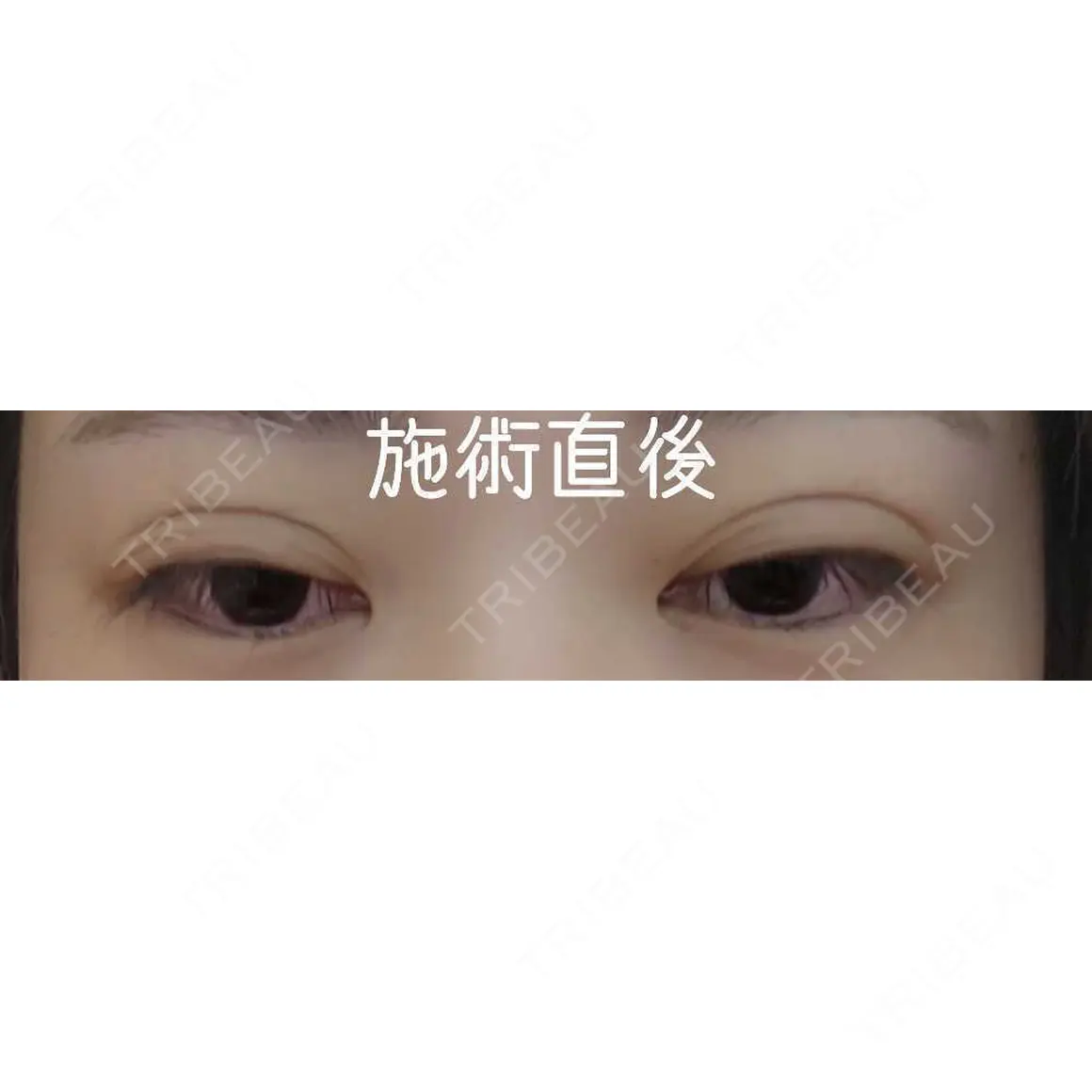 二重埋没 アリエル美容クリニック 郡山院 DAY 0