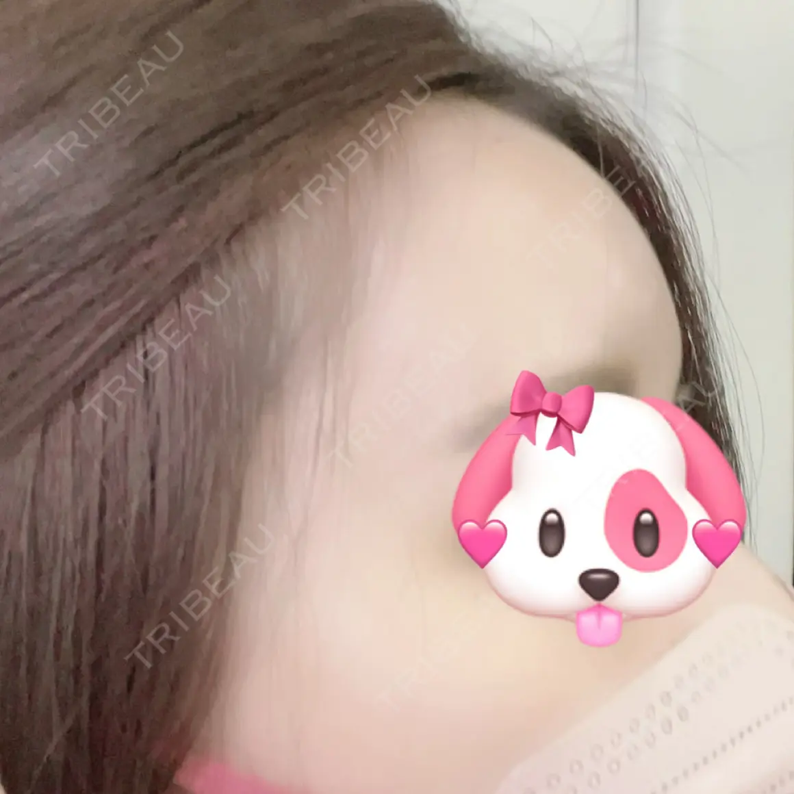 ヒアルロン酸注入（額） APスキンクリニック銀座 DAY 0