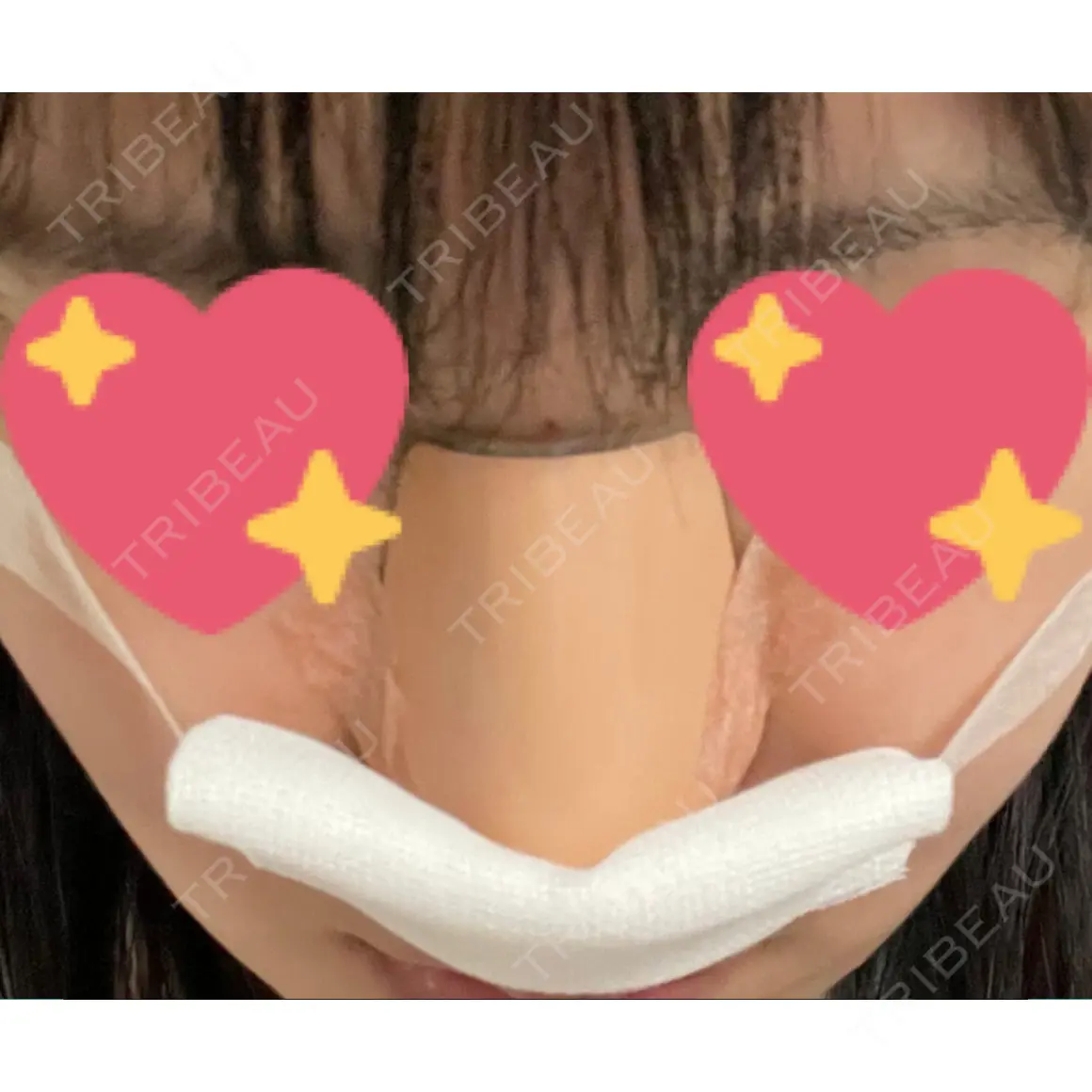 鼻尖形成（切開） Zetith Beauty Clinic 銀座院 DAY 1