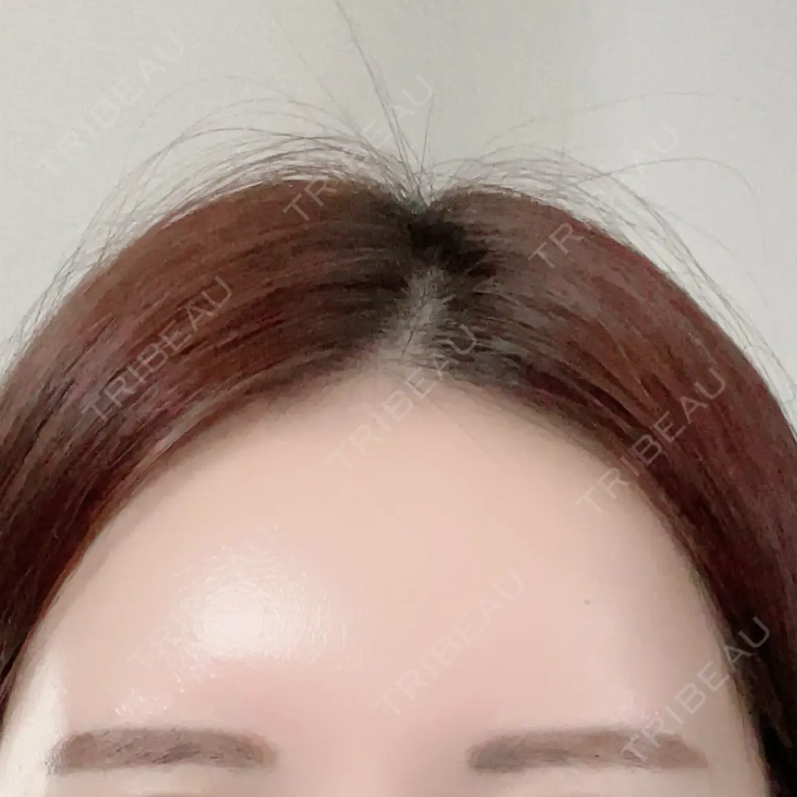 ヒアルロン酸注入（額） APスキンクリニック銀座 AFTER