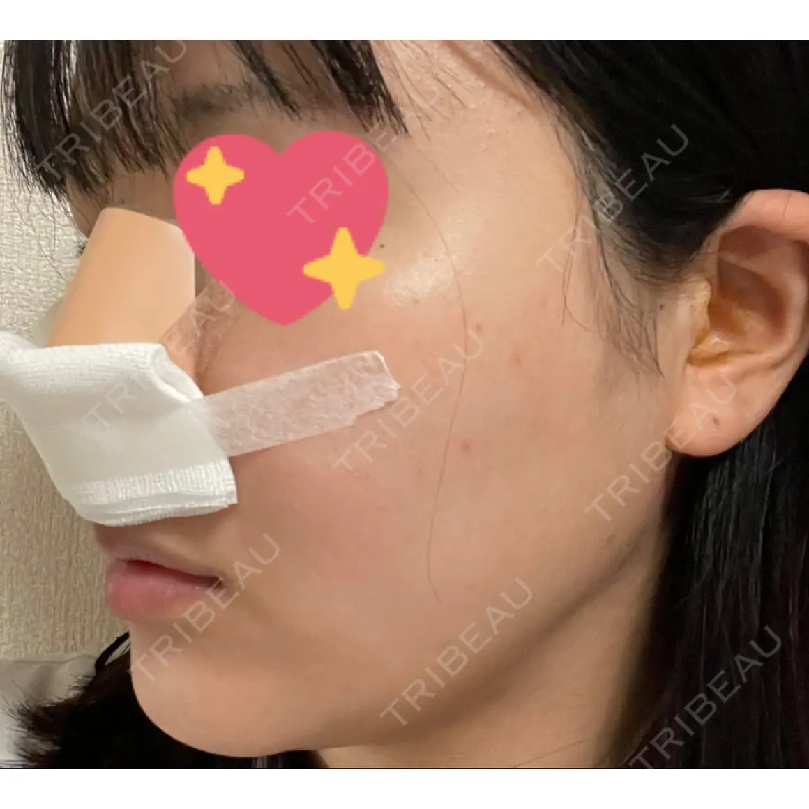 プロテーゼ除去 Zetith Beauty Clinic 銀座院 DAY 1