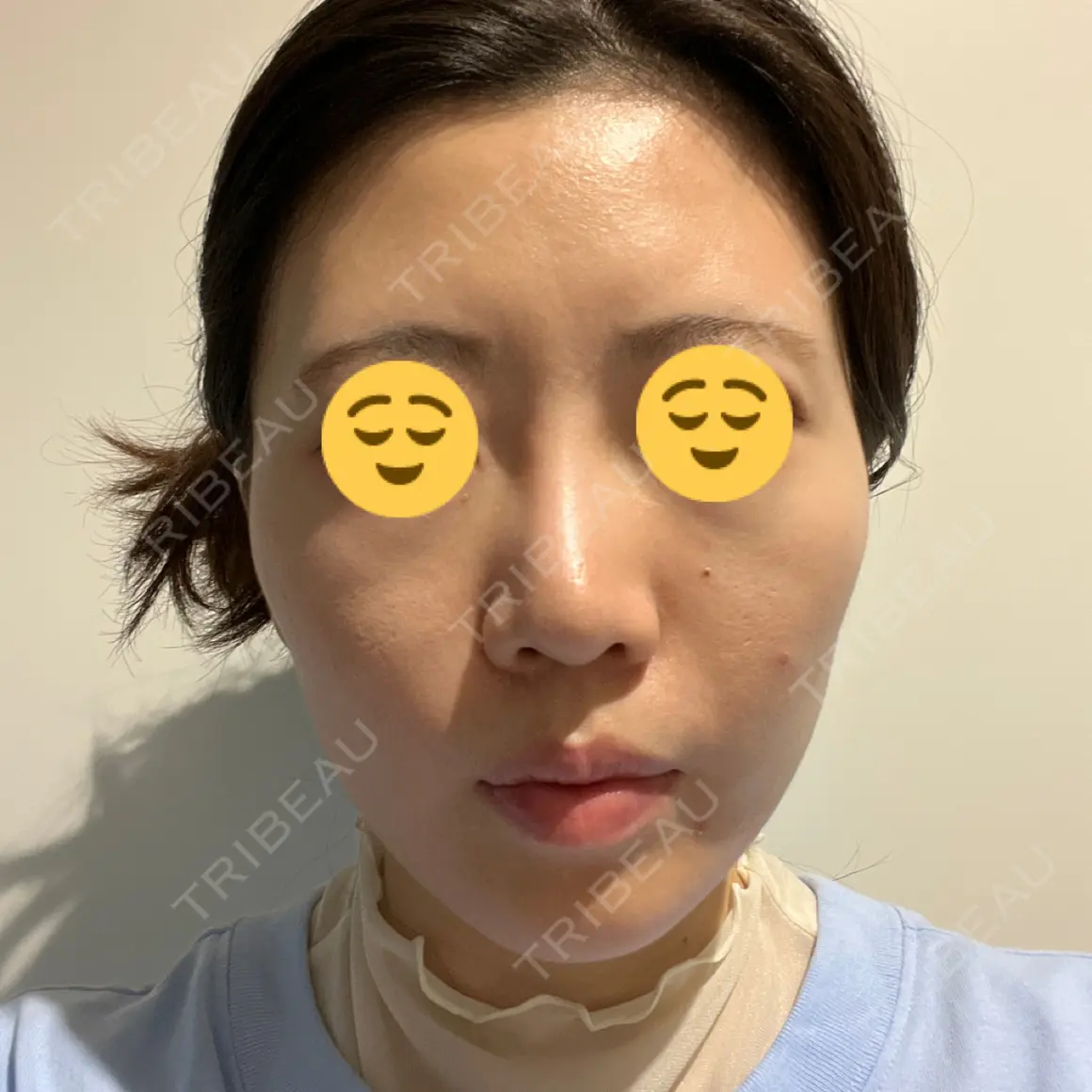 イオン導入 / ピーリング（ハリ・ツヤ） 湘南美容クリニック 静岡院 AFTER