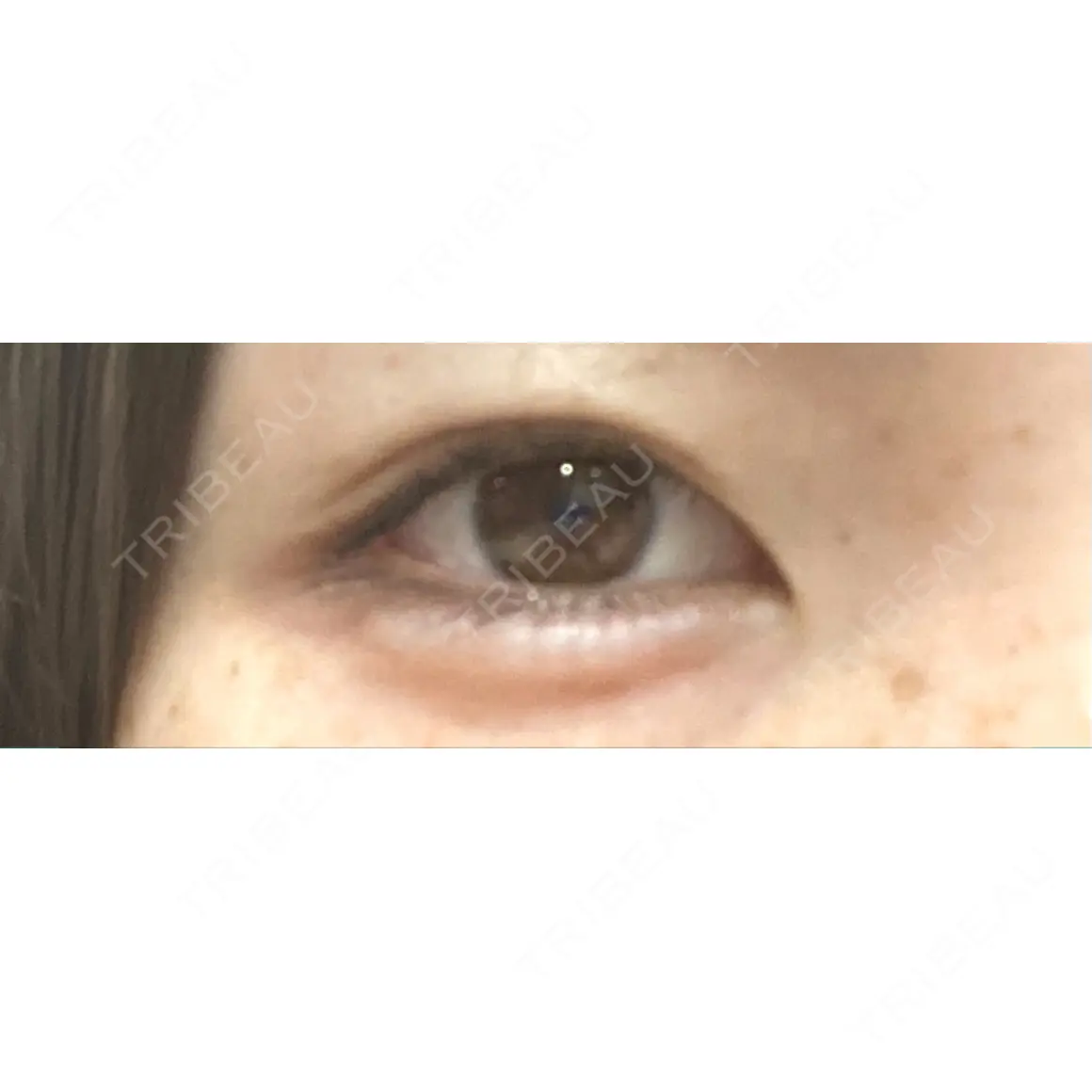 ヒアルロン酸注入（涙袋） 宇都宮竹内クリニック AFTER